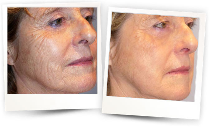 Courtesy-of-Dr-Bernard-Mole-France Courtesy-of-Dr-Bernard-Mole-France